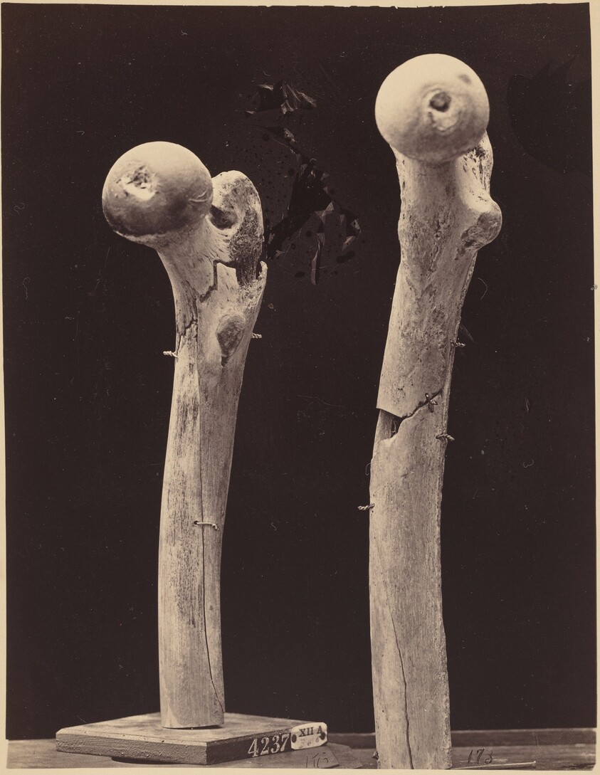 Specimens of Gunshot Fractures of the Femur