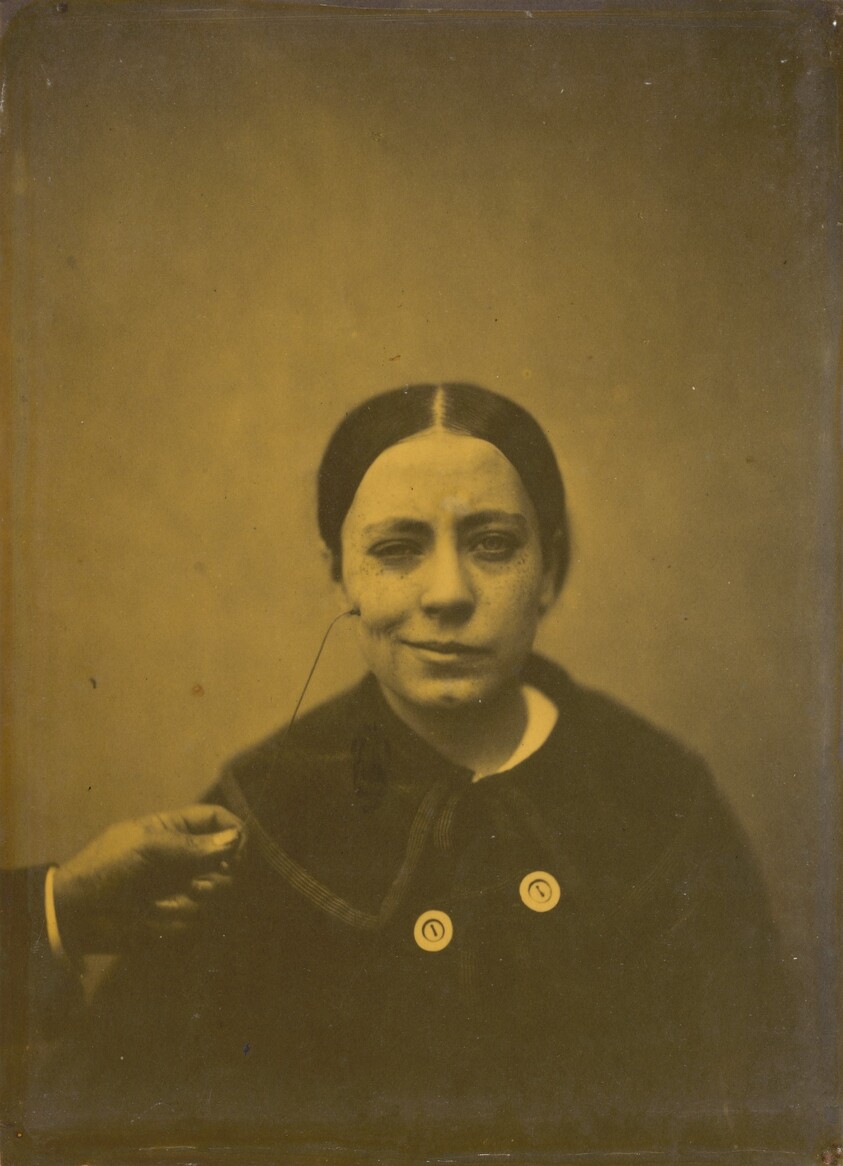 Slight lowering of the angle of the mouth due to depression (left); False laughter (right)