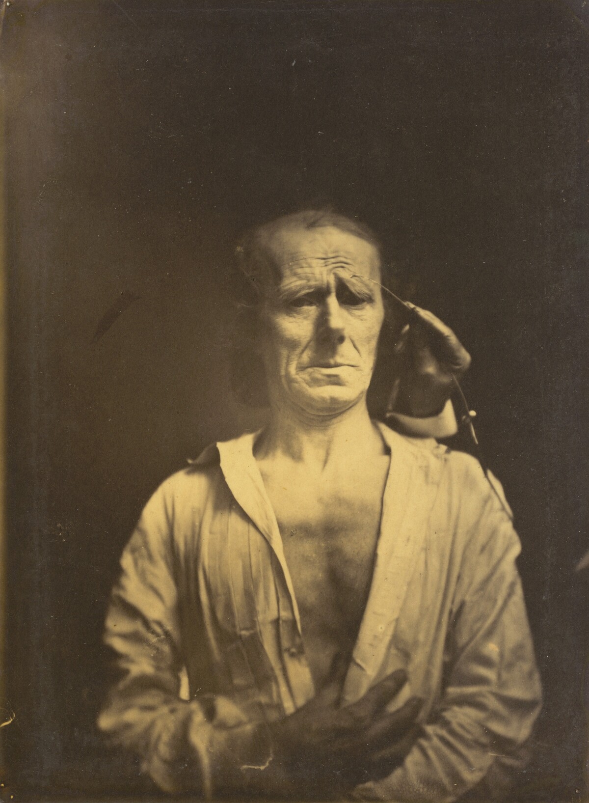 Spasm of m. corrugator supercilii under very strong light (left); A relaxed face (photographed in full sunshine) (right)
