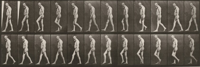 Plate Number 555. Muscular atrophy of legs, adult, walking