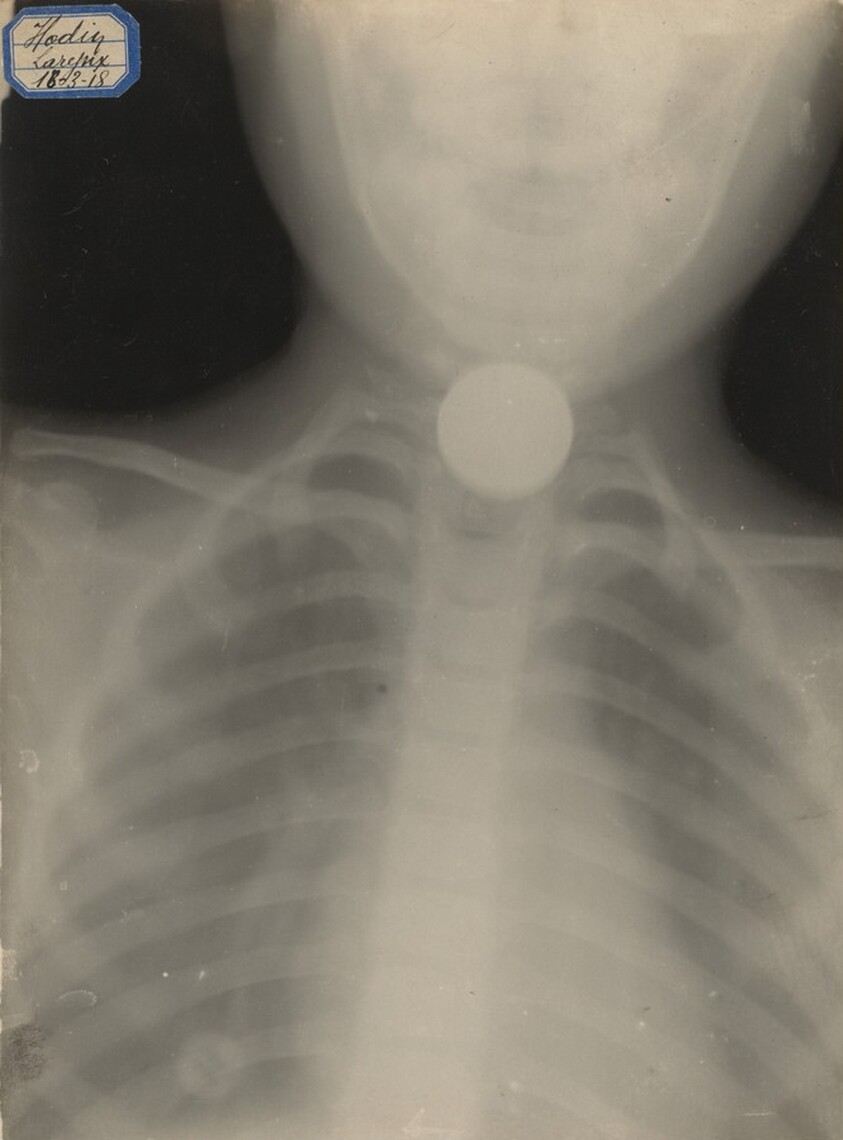 Swallowed Coin, Military Hospital