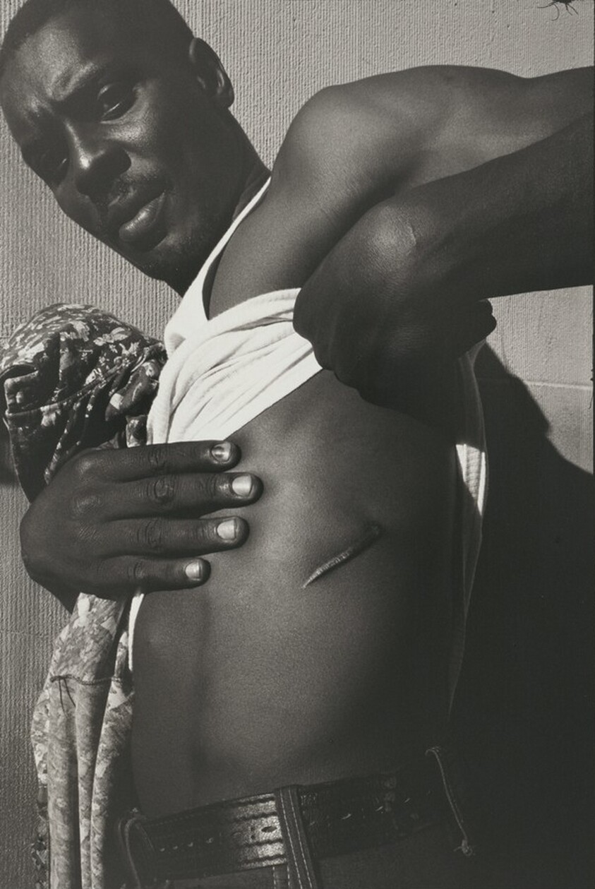 A 14th Street drug pusher shows one of his many knife wounds, shortly after this photo was taken he was stabbed again, New York City